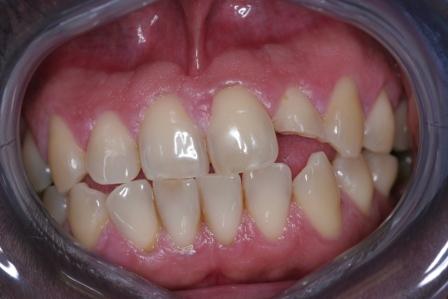 Broken Lateral